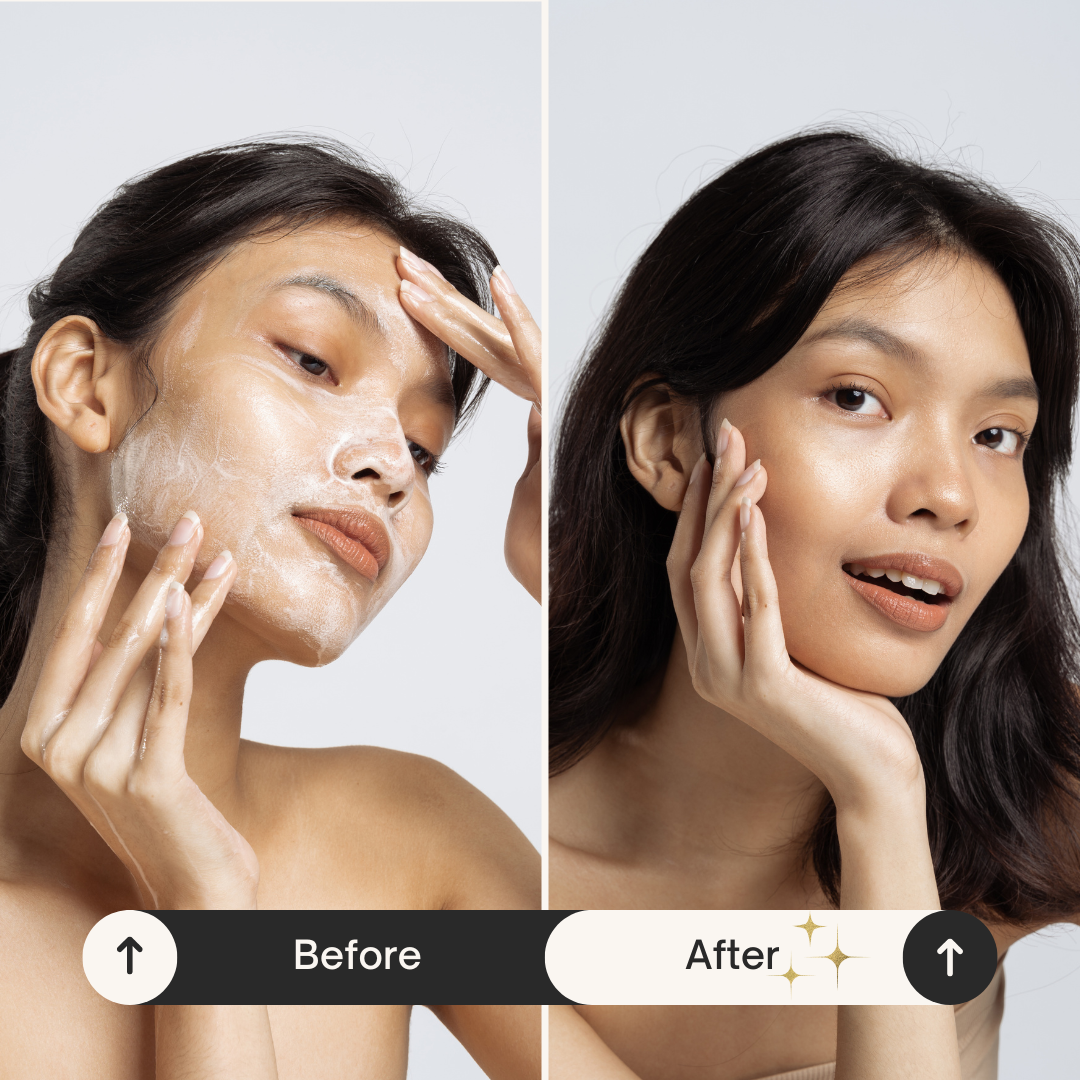 Olyra Bye Acne Kit